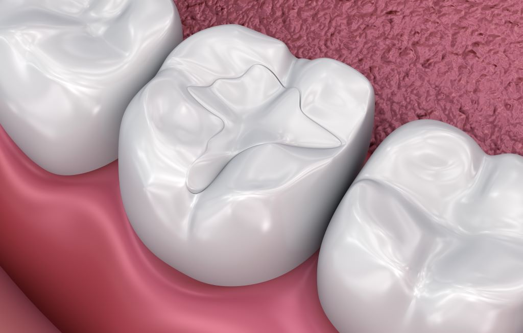 composite fillings san carlos