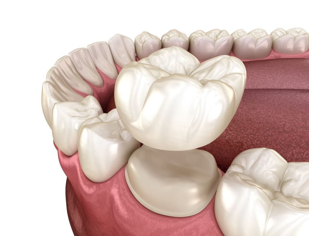 dental crowns san carlos