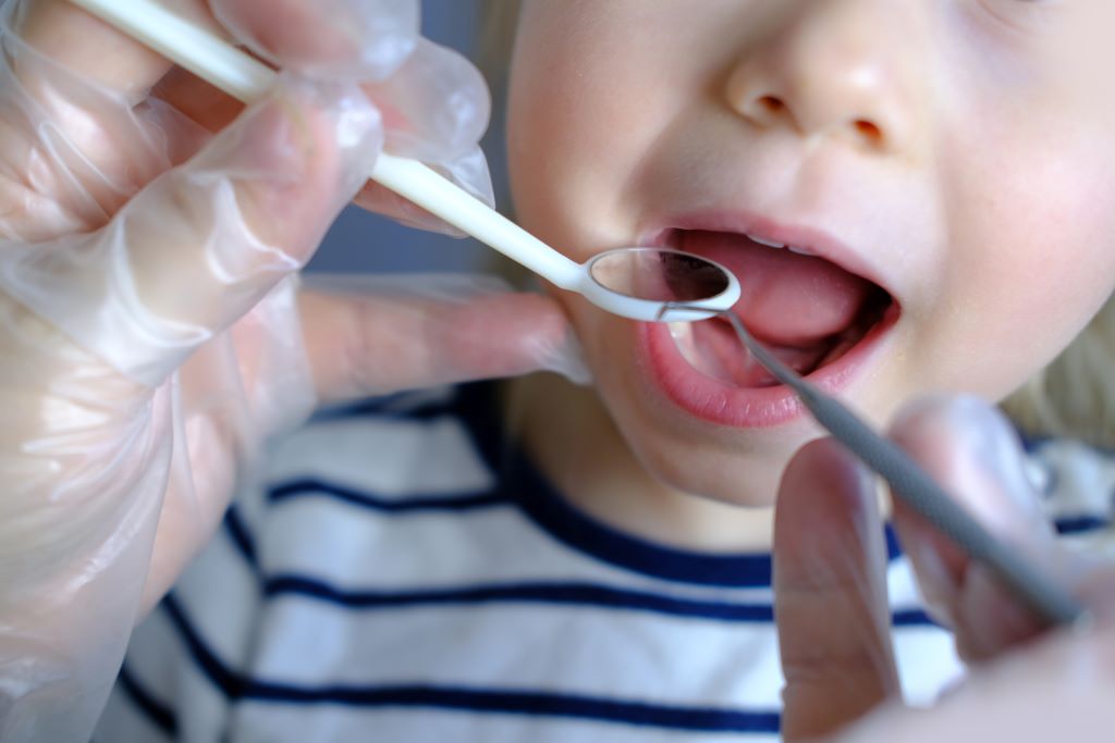 dental fillings san carlos